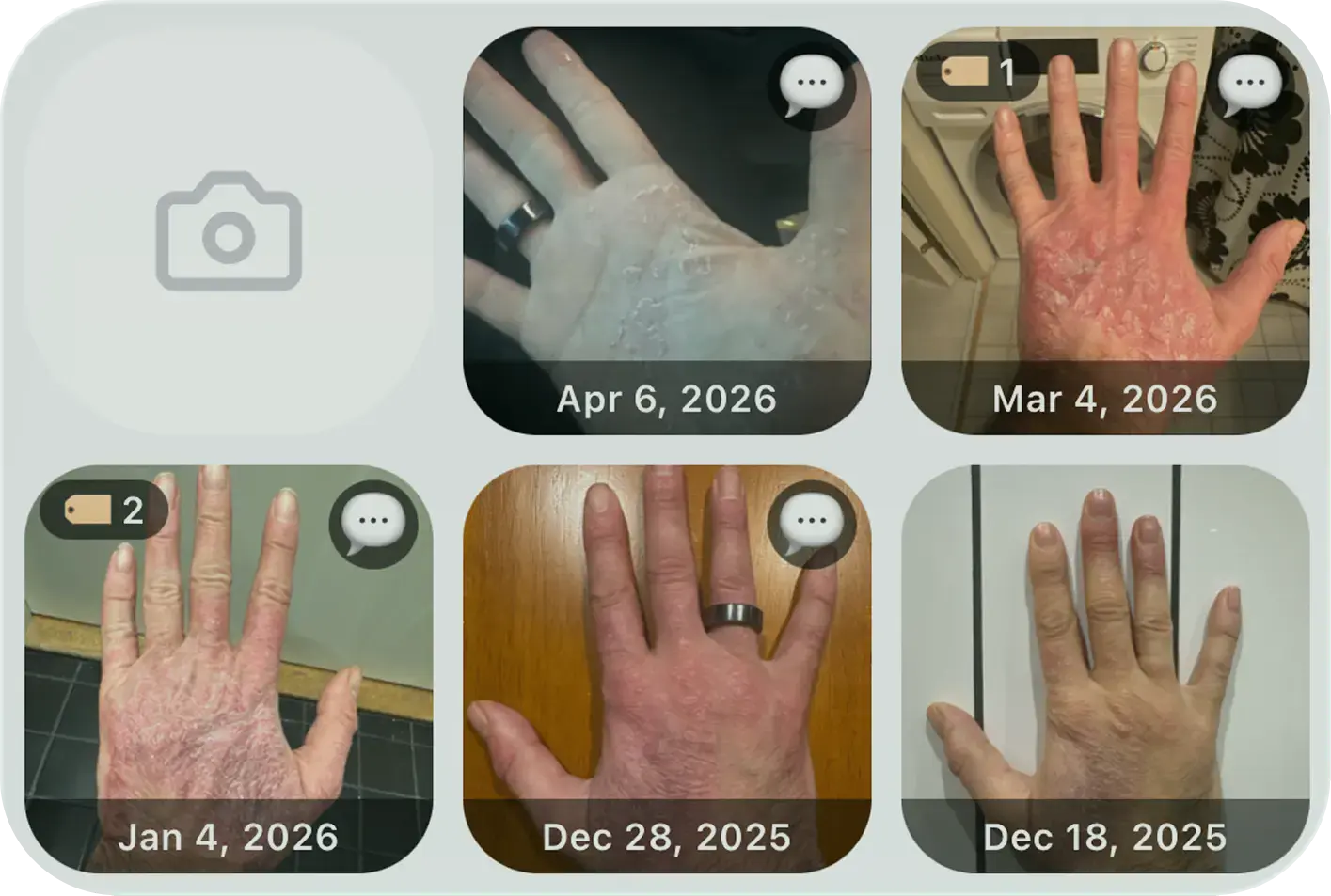 Itchi skin photo diary showing before and after psoriasis tracking with dated entries
